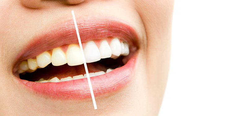 Guide on teeth whitening: A bright, radiant smile with tips and methods for enhancing the appearance of your teeth and achieving a whiter smile. Includes information on different whitening methods and considerations for optimal results.